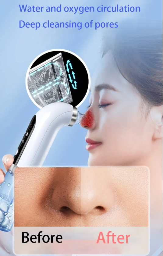 DermaSuction Pro™ Blackhead Remover